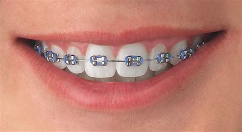 ligas de brackets azul metalico|colores de brackets.